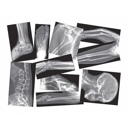 Broken Bones X-rays Set,pk15 (1 Units In